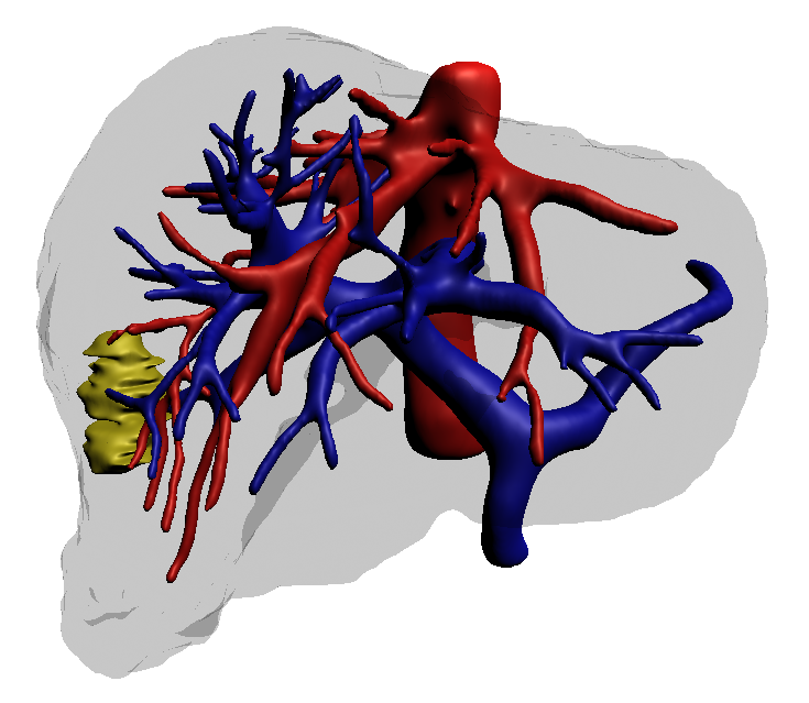 3D reconstruction of the same case showing hepatic vein in red, portal vein in blue, and tumor in yellow