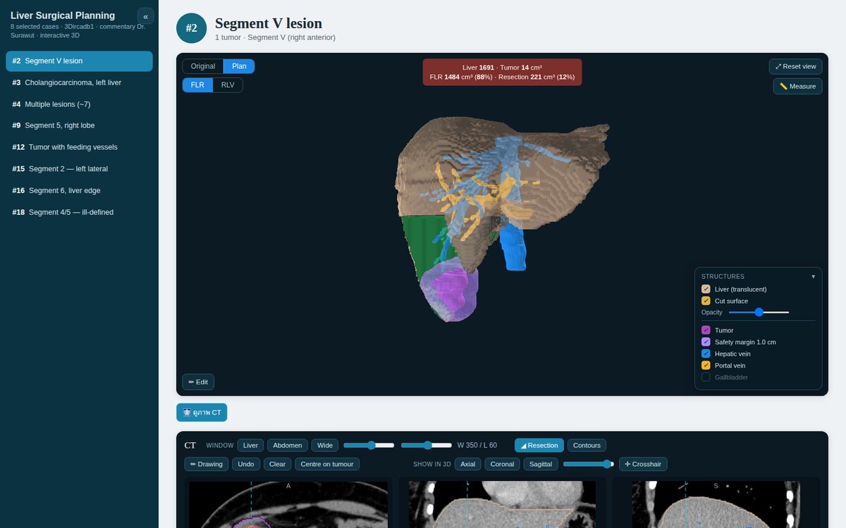 The report's resection plan view showing the planned resection region, safety margin, and volume readout including future liver remnant
