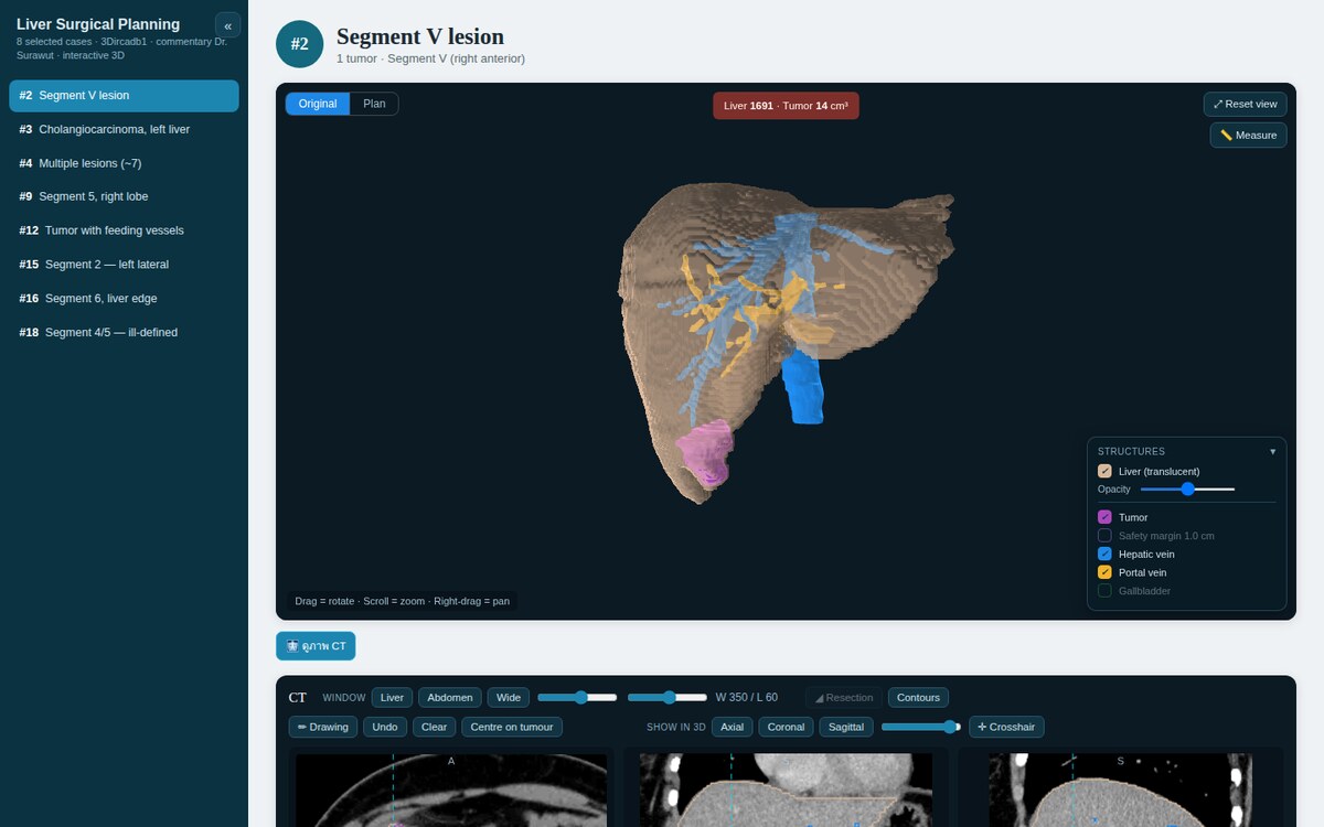 The interactive 3D report showing a case's 3D liver model with tumor, structure toggles, and linked CT views