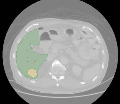Axial CT slice with the liver in green and the tumor in yellow