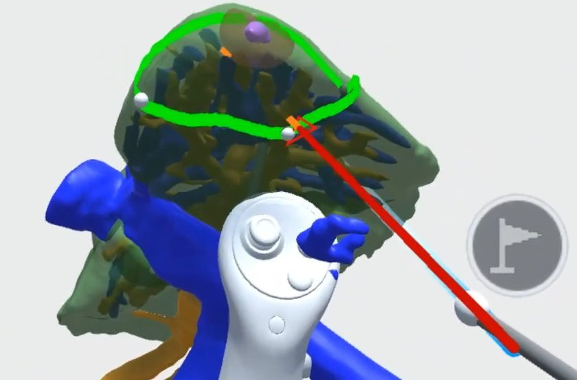 The Landmark tool: pins placed on the liver surface with the cut line redrawn through each added pin