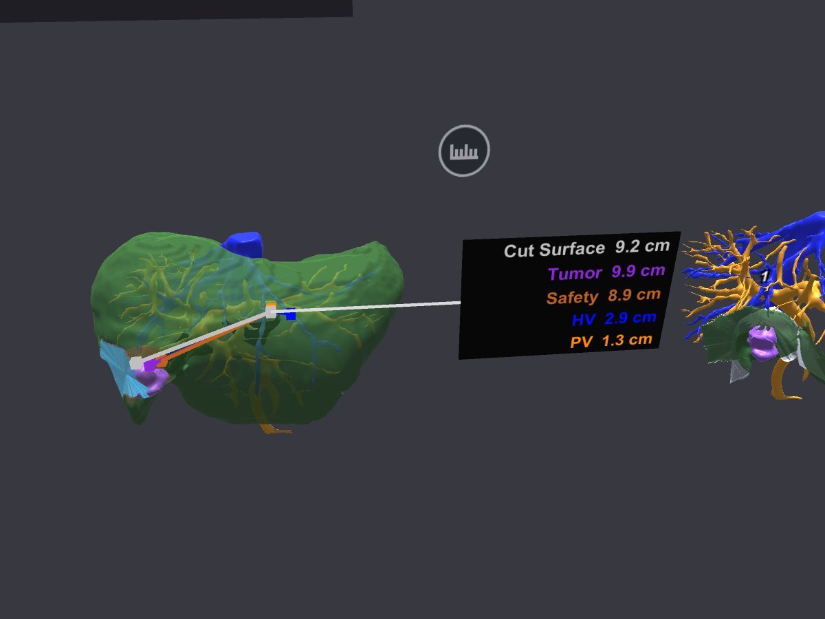Automatic distances shown in VR to the tumor margin, vessels, and liver surface