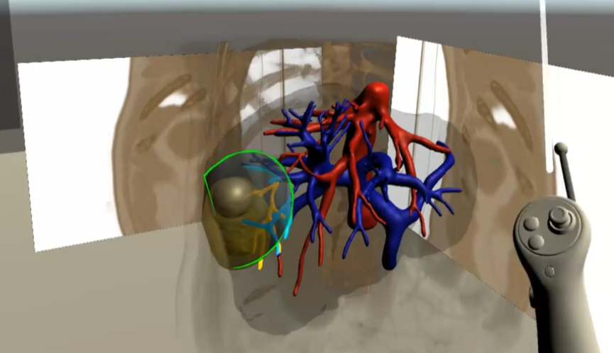 Resection planning view inside the VR system with controller