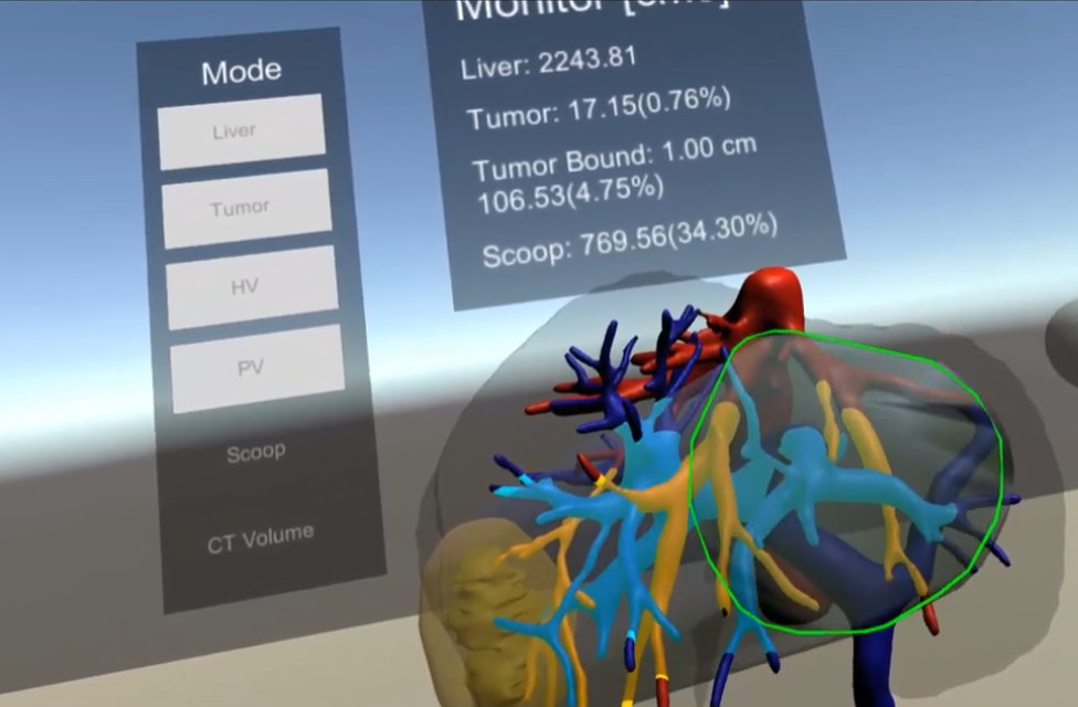VR view of liver, vessel trees, and tumor with the volume monitor